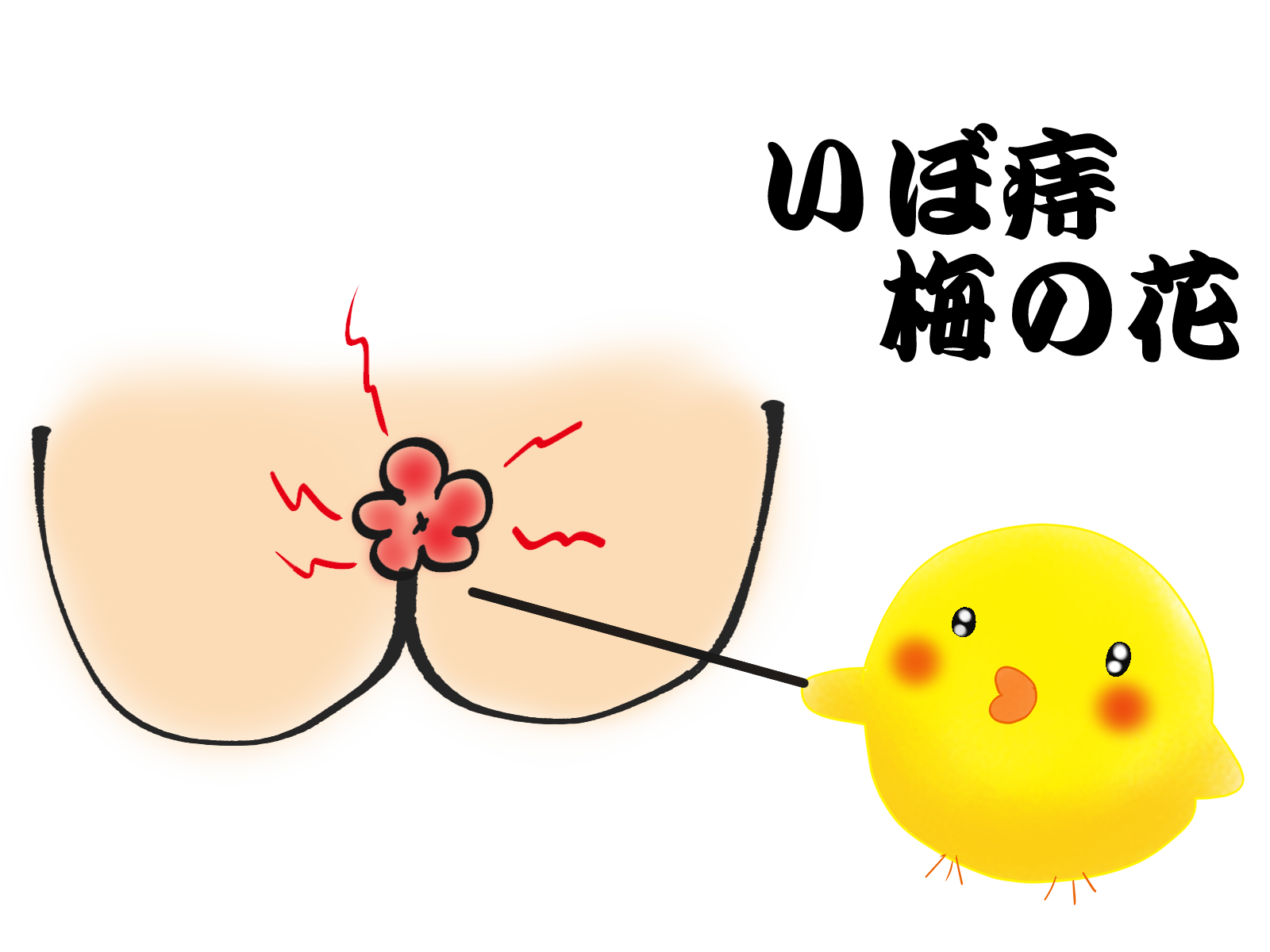 いぼ痔