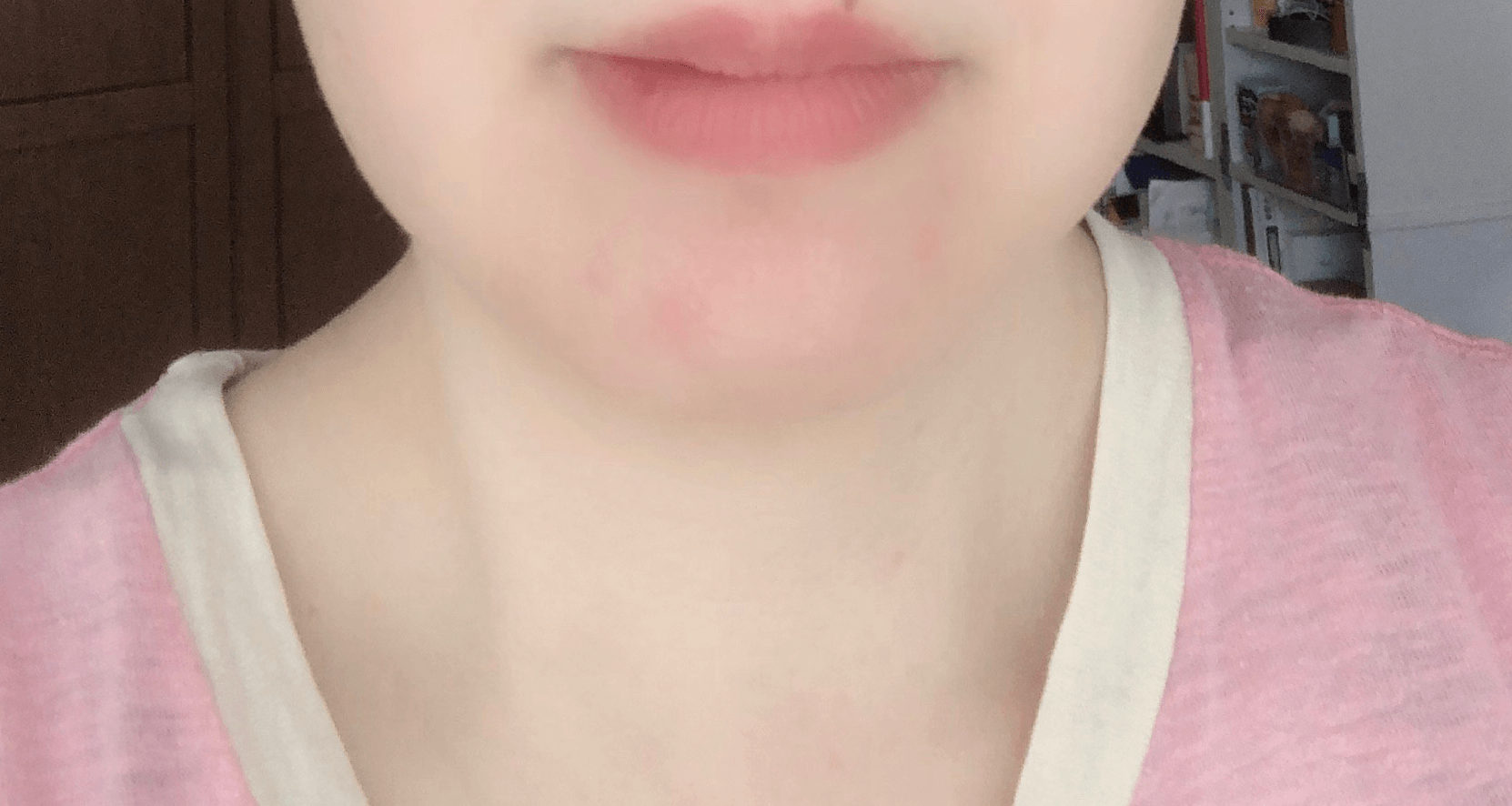あごニキビ
