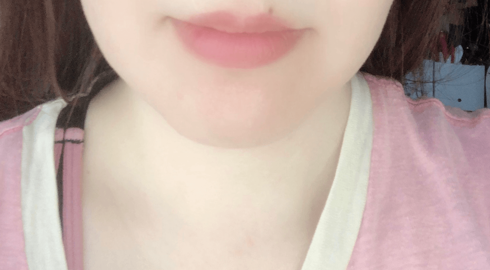 あごニキビ
